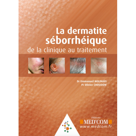 La dermatite séborrhéique : de la clinique au traitement