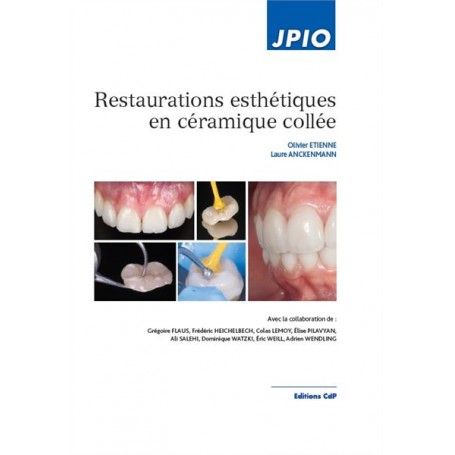 Restaurations esthétiques en céramique colée       