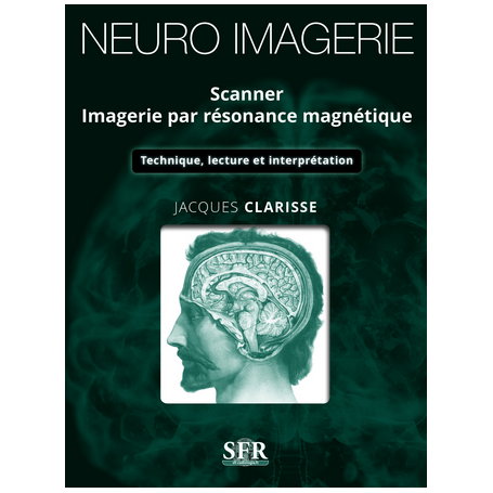 Neuro-imegerie : scanner, imagerie par résonance magnétique